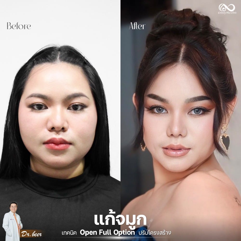 รีวิว แก้จมูก #1267 , Century Clinic Thailand แก้จมูก 1#1267
