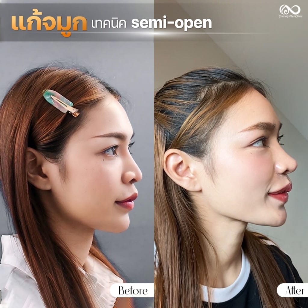 แก้จมูก 1#1275