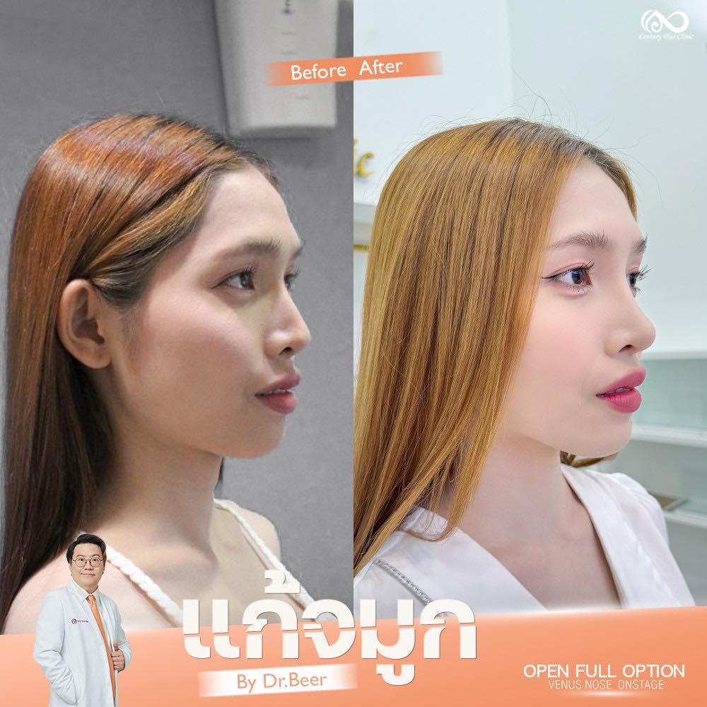 แก้จมูก 1#1302