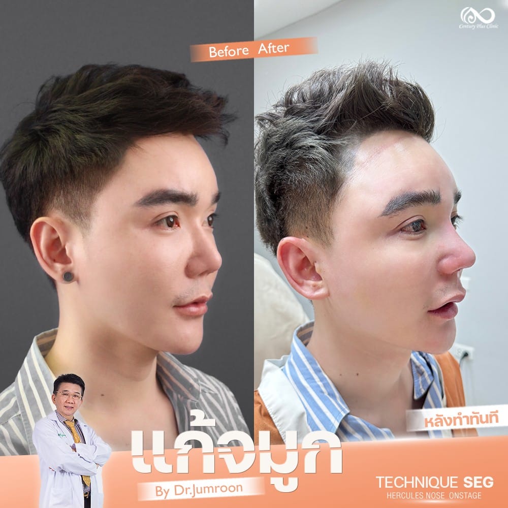แก้จมูก 1#1303