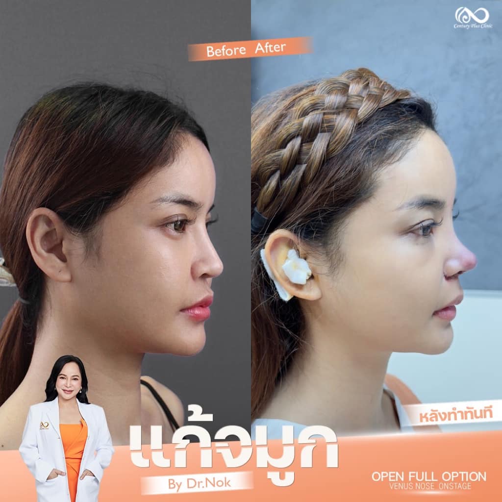 แก้จมูก 1#1304