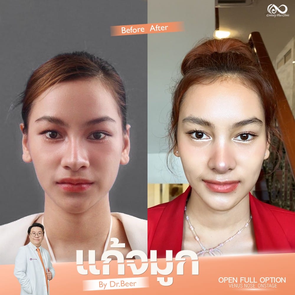 รีวิว แก้จมูก #1308 , Century Clinic Thailand แก้จมูก 1#1308