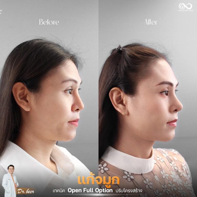แก้จมูก #1269