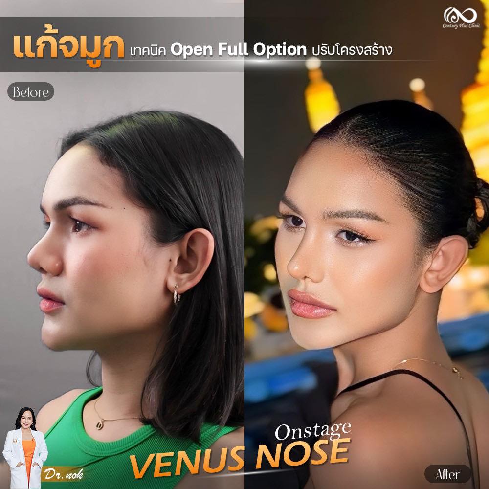 รีวิว แก้จมูก #1289 , Century Clinic Thailand แก้จมูก #1289