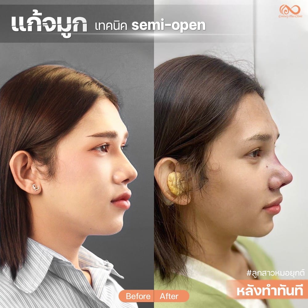 รีวิว แก้จมูก #1296 , Century Clinic Thailand แก้จมูก #1296