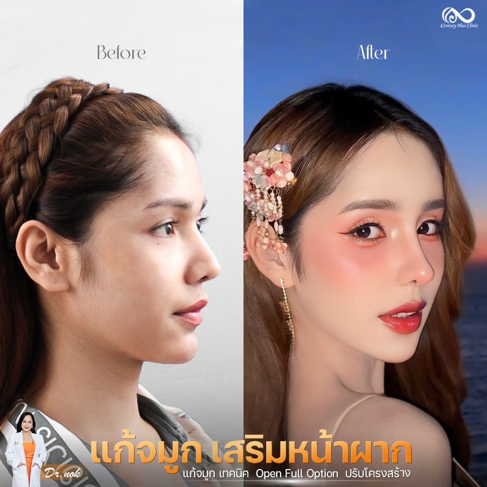แก้จมูก 2#1258