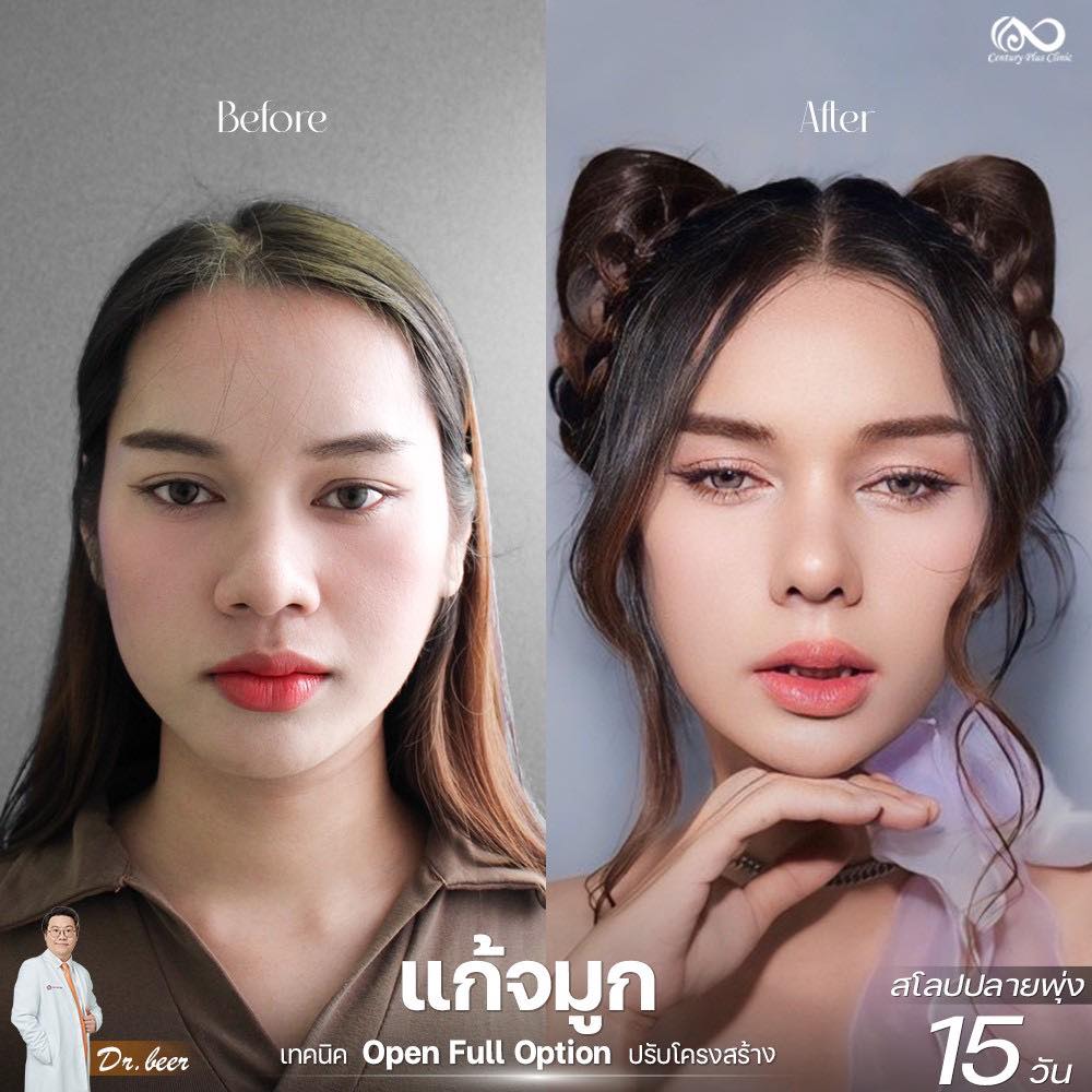 รีวิว แก้จมูก #1264 , Century Clinic Thailand แก้จมูก 2#1264