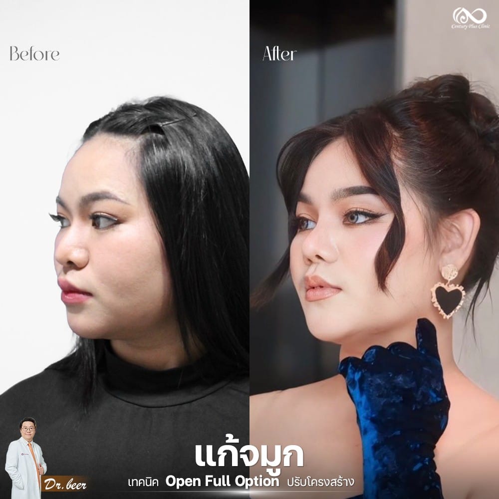 รีวิว แก้จมูก #1267 , Century Clinic Thailand แก้จมูก 2#1267
