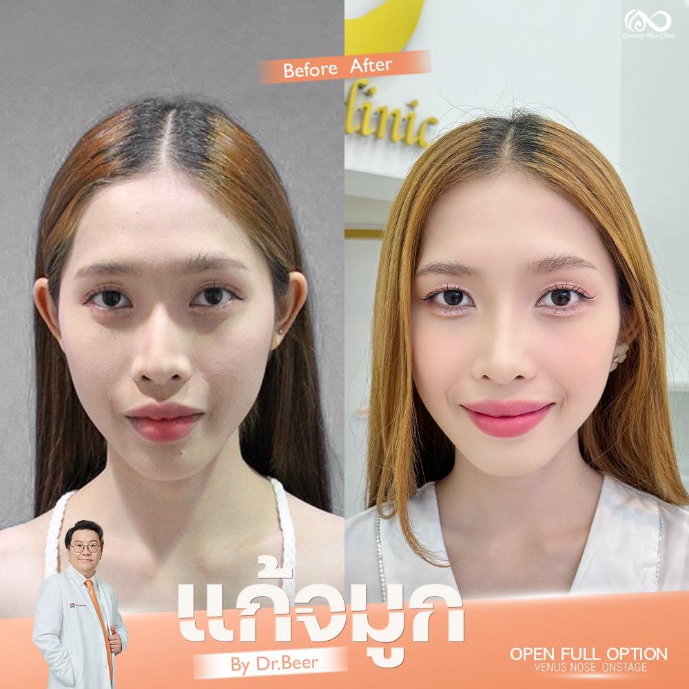 แก้จมูก 2#1302