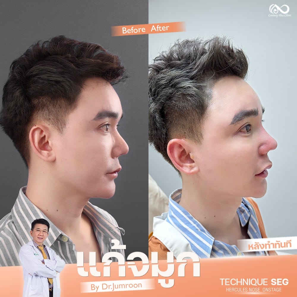 แก้จมูก 2#1303