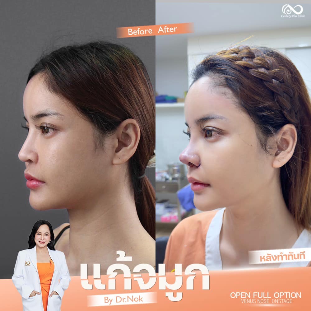 แก้จมูก 2#1304
