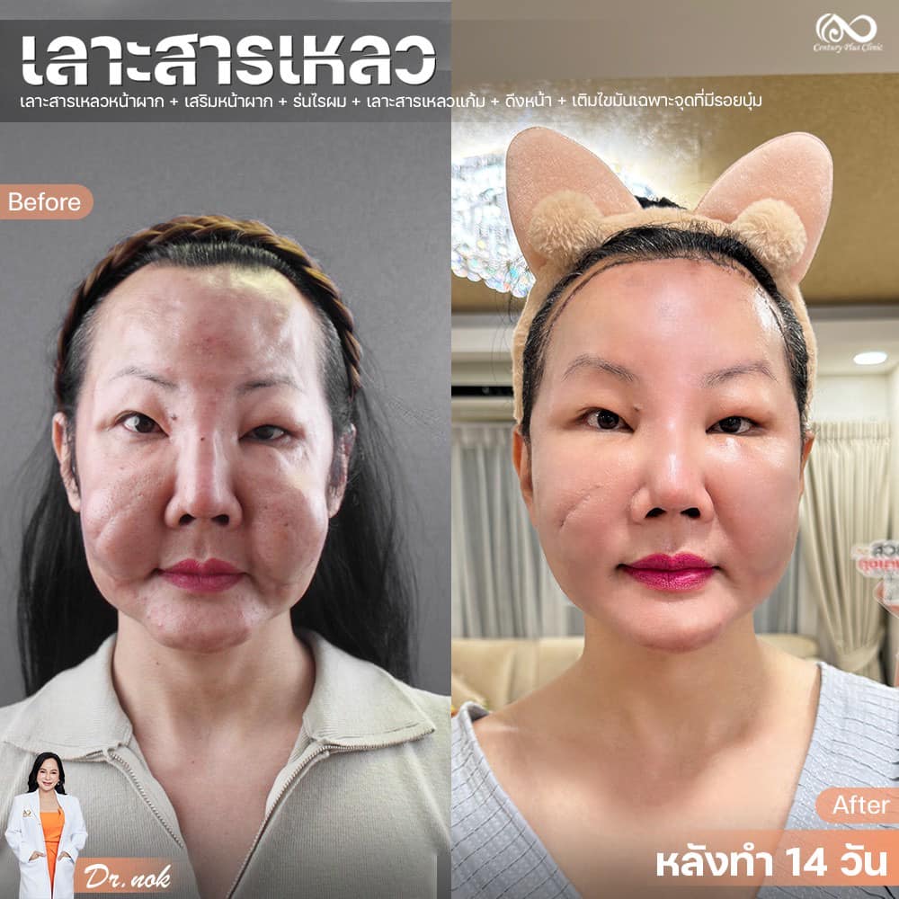 หน้าผาก #47