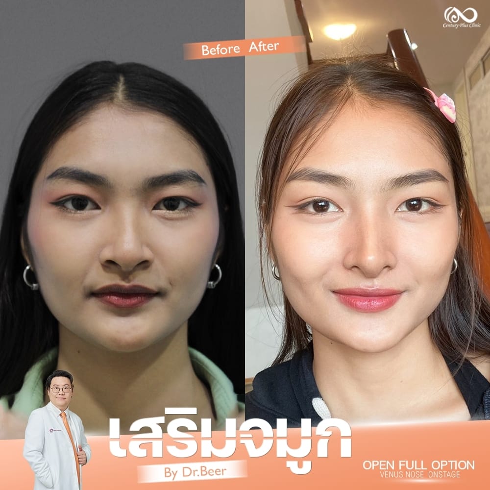 รีวิว เสริมจมูก #1332 , Century Clinic Thailand เสริมจมูก 1#1332