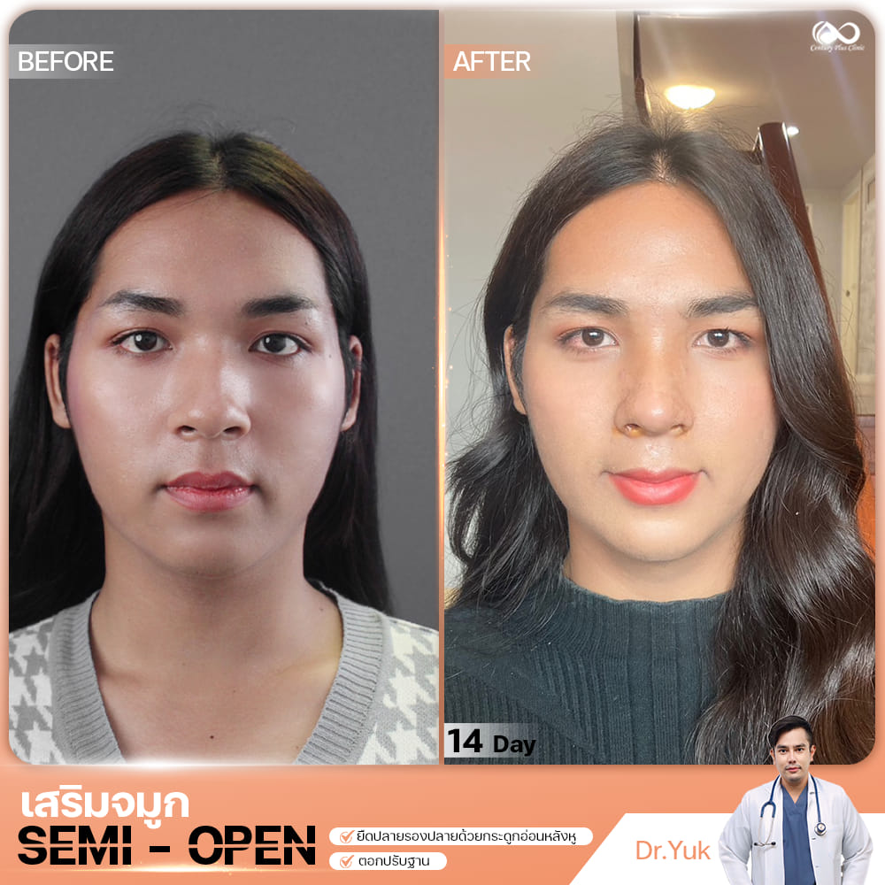 รีวิว เสริมจมูก #1333 , Century Clinic Thailand เสริมจมูก 1#1333