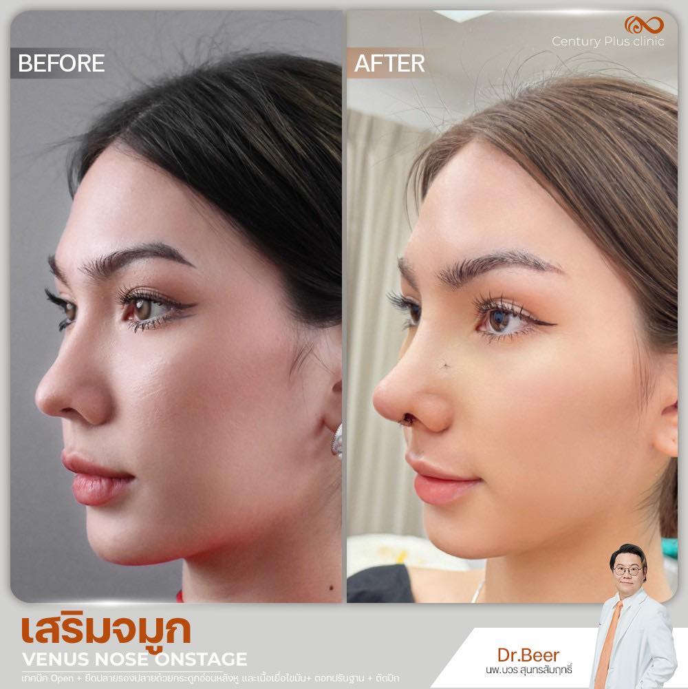 รีวิว เสริมจมูก #1350 , Century Clinic Thailand เสริมจมูก 1#1350