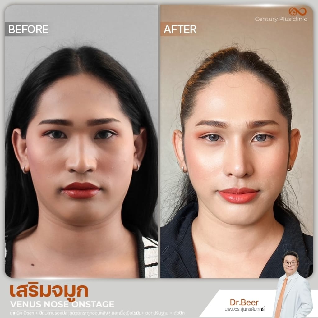 รีวิว เสริมจมูก #1356 , Century Clinic Thailand เสริมจมูก 1#1356