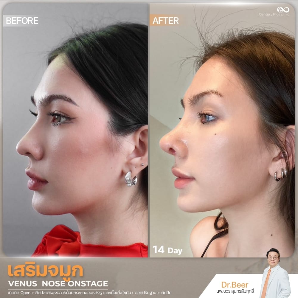 รีวิว เสริมจมูก #1366 , Century Clinic Thailand เสริมจมูก 1#1366