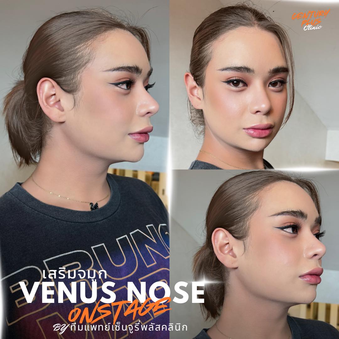 รีวิว เสริมจมูก #1331 , Century Clinic Thailand เสริมจมูก #1331