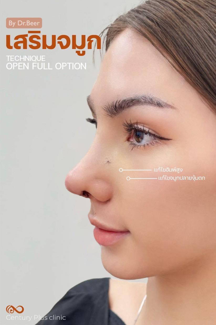 รีวิว เสริมจมูก #1350 , Century Clinic Thailand เสริมจมูก #1350