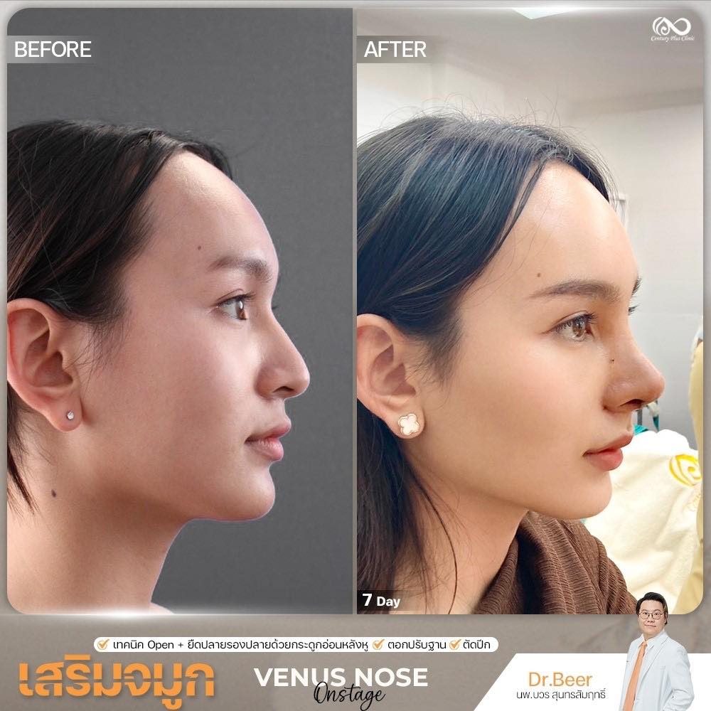 เสริมจมูก #1357
