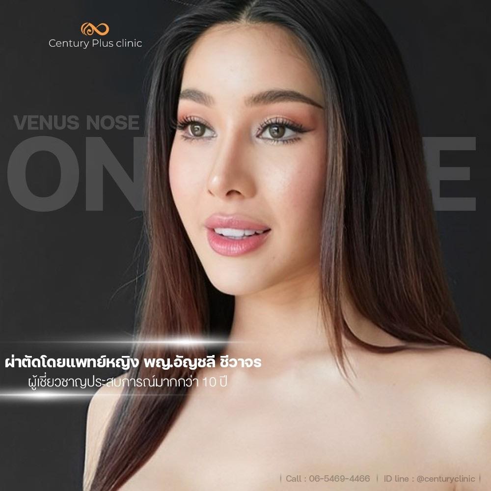 เสริมจมูก #1363