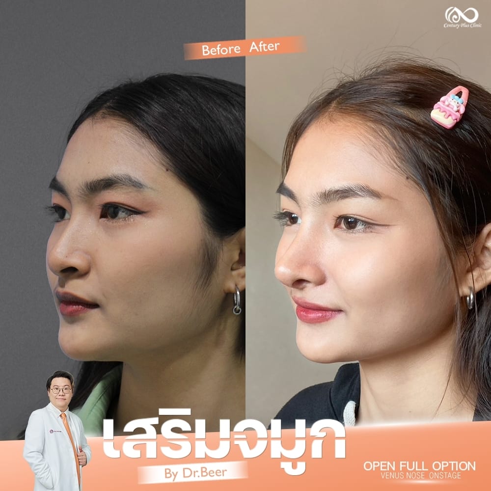 รีวิว เสริมจมูก #1332 , Century Clinic Thailand เสริมจมูก 2#1332