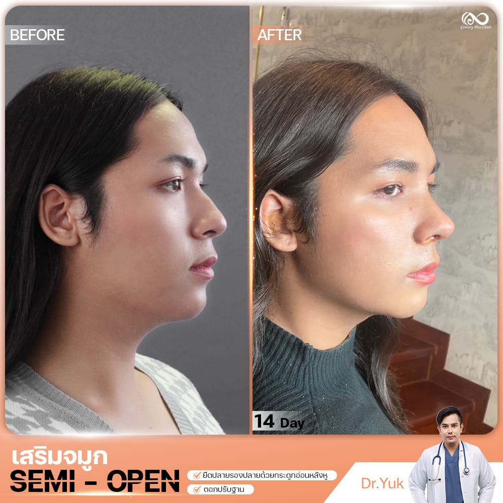 รีวิว เสริมจมูก #1333 , Century Clinic Thailand เสริมจมูก 2#1333