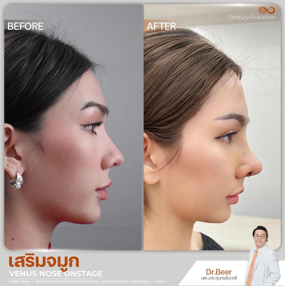 รีวิว เสริมจมูก #1350 , Century Clinic Thailand เสริมจมูก 2#1350