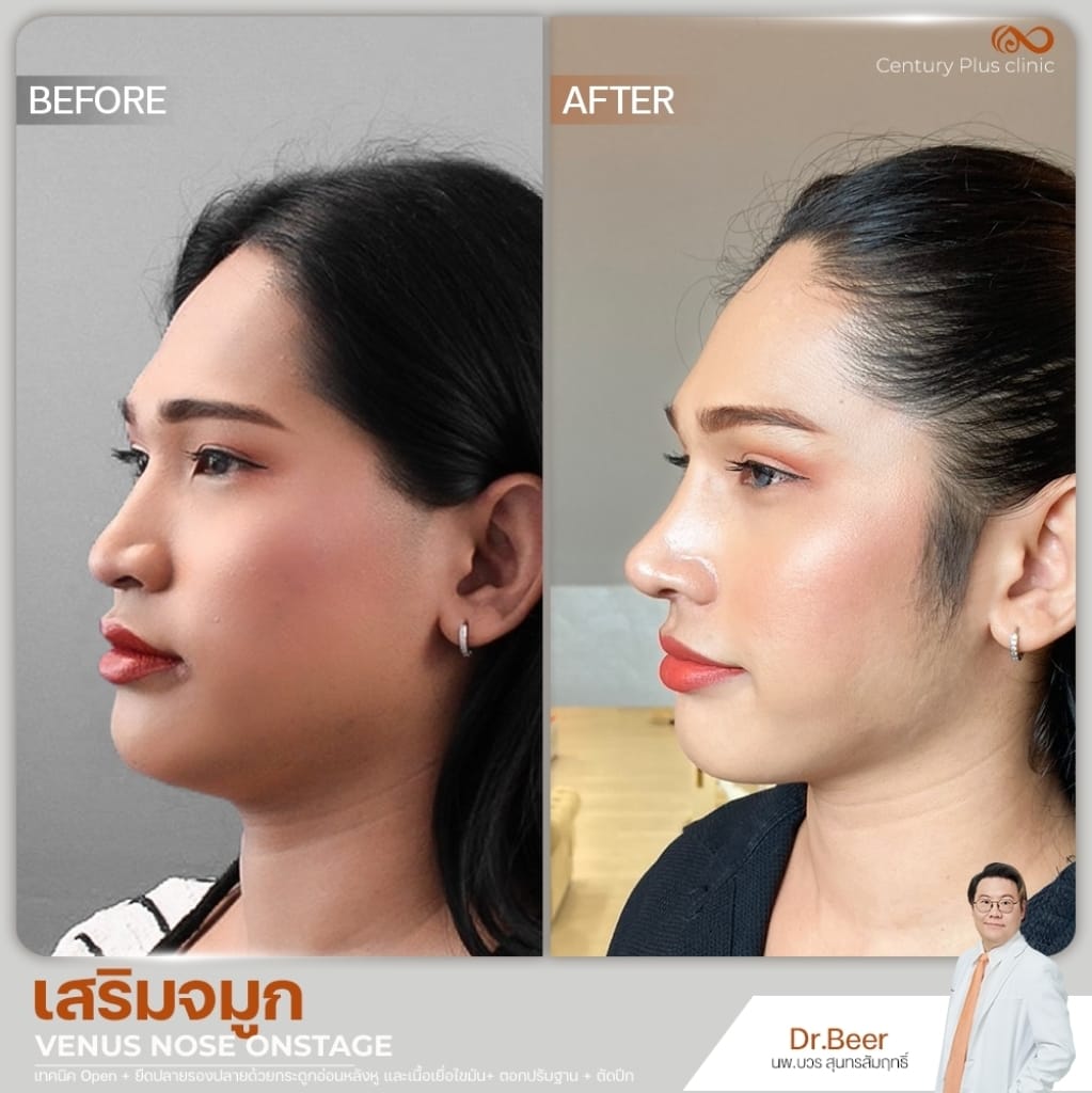 รีวิว เสริมจมูก #1356 , Century Clinic Thailand เสริมจมูก 2#1356