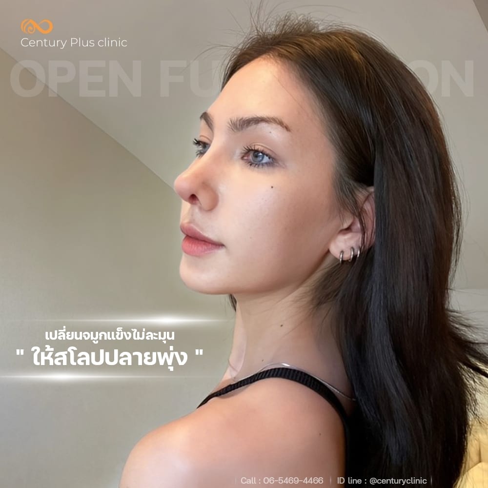 รีวิว เสริมจมูก #1366 , Century Clinic Thailand เสริมจมูก 2#1366
