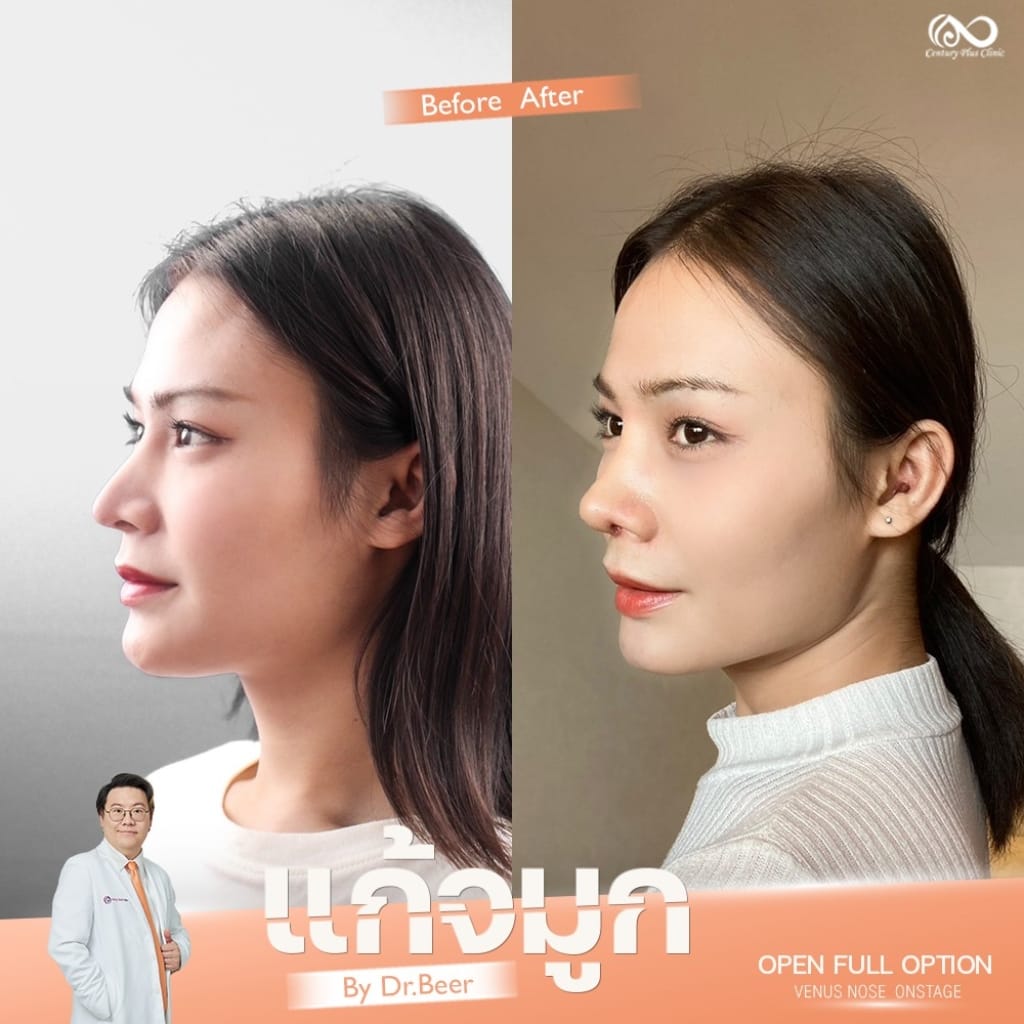 แก้จมูก 1#1318