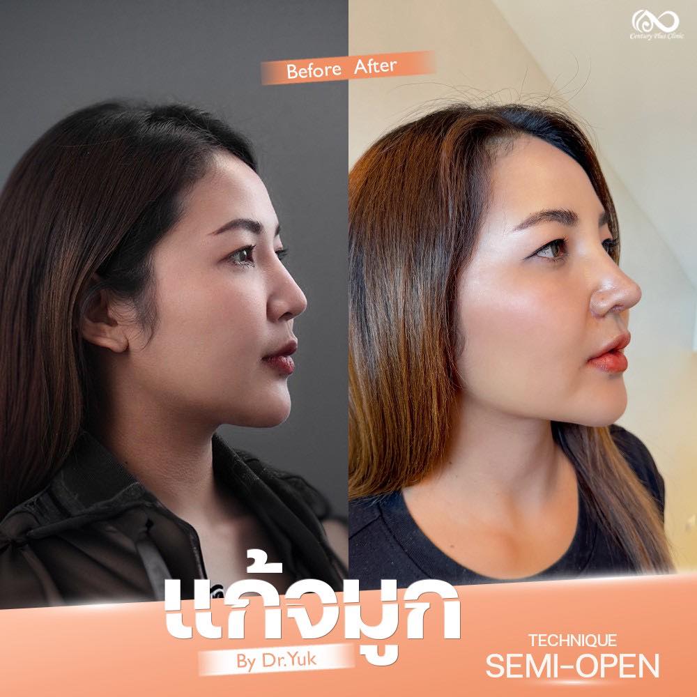 แก้จมูก 1#1320