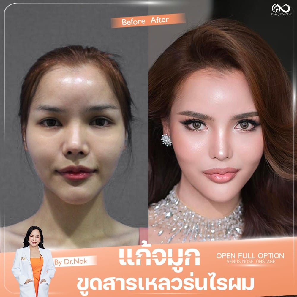 รีวิว แก้จมูก #1334 , Century Clinic Thailand แก้จมูก 1#1334