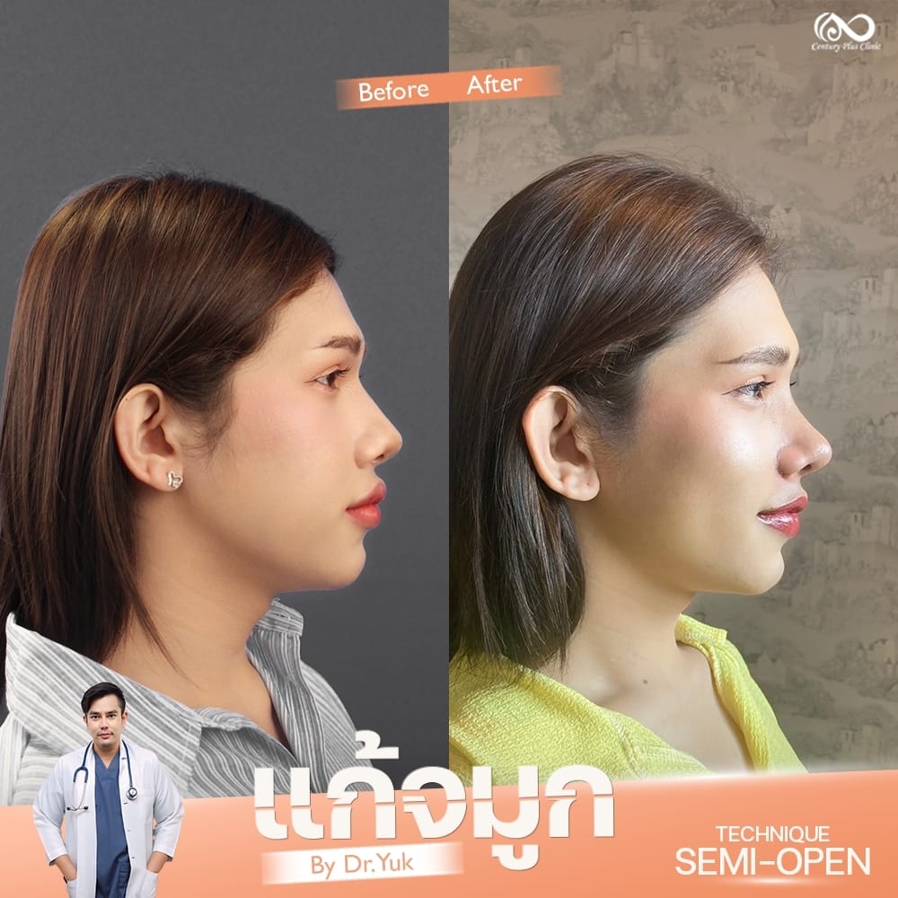 รีวิว แก้จมูก #1336 , Century Clinic Thailand แก้จมูก 1#1336