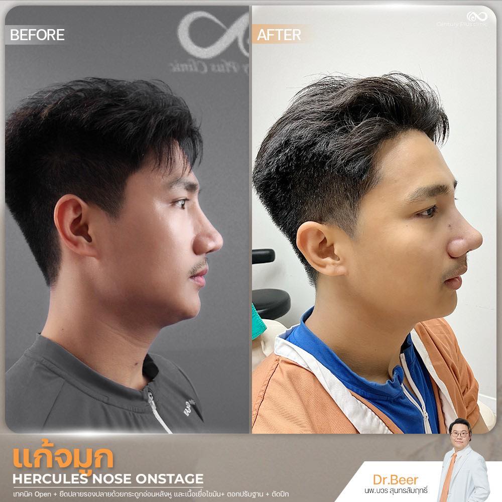 รีวิว แก้จมูก #1367 , Century Clinic Thailand แก้จมูก 1#1367