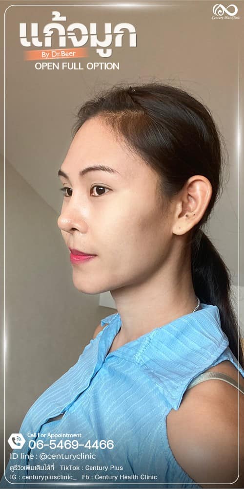 แก้จมูก #1319