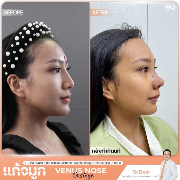 แก้จมูก #1335