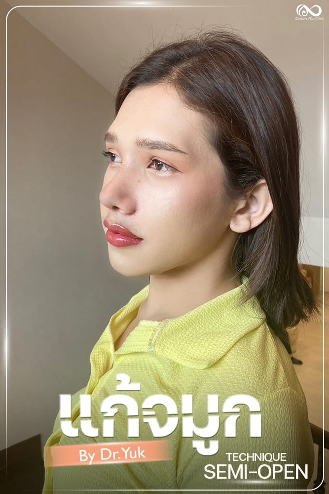 แก้จมูก #1336