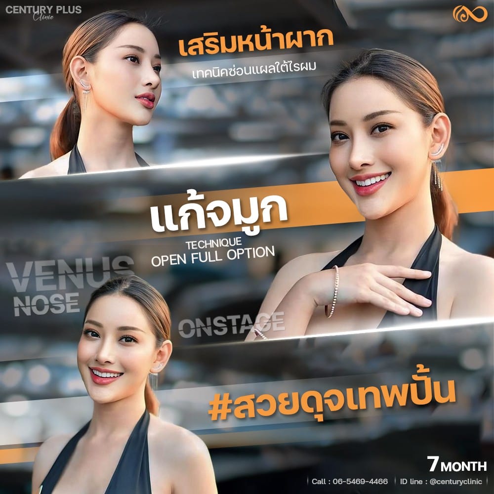 รีวิว แก้จมูก #1339 , Century Clinic Thailand แก้จมูก #1339