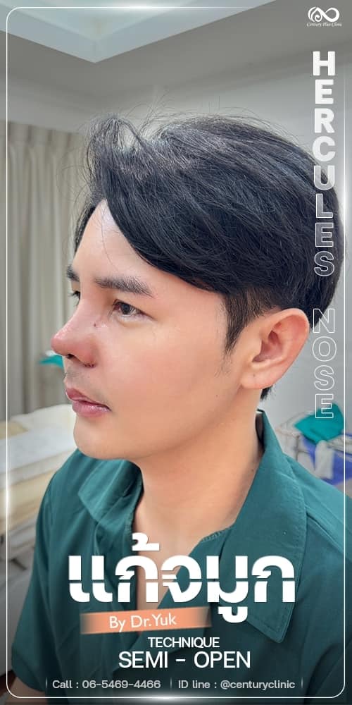 แก้จมูก #1342