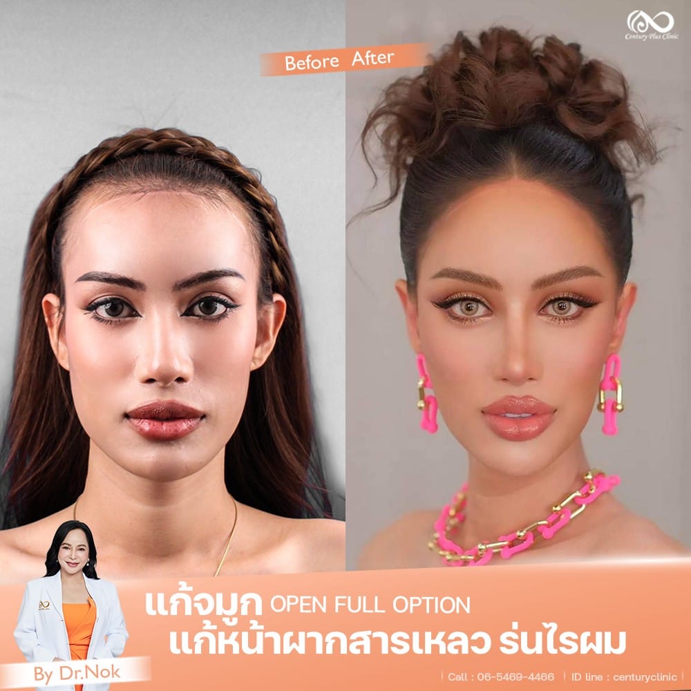 แก้จมูก 2 #1316