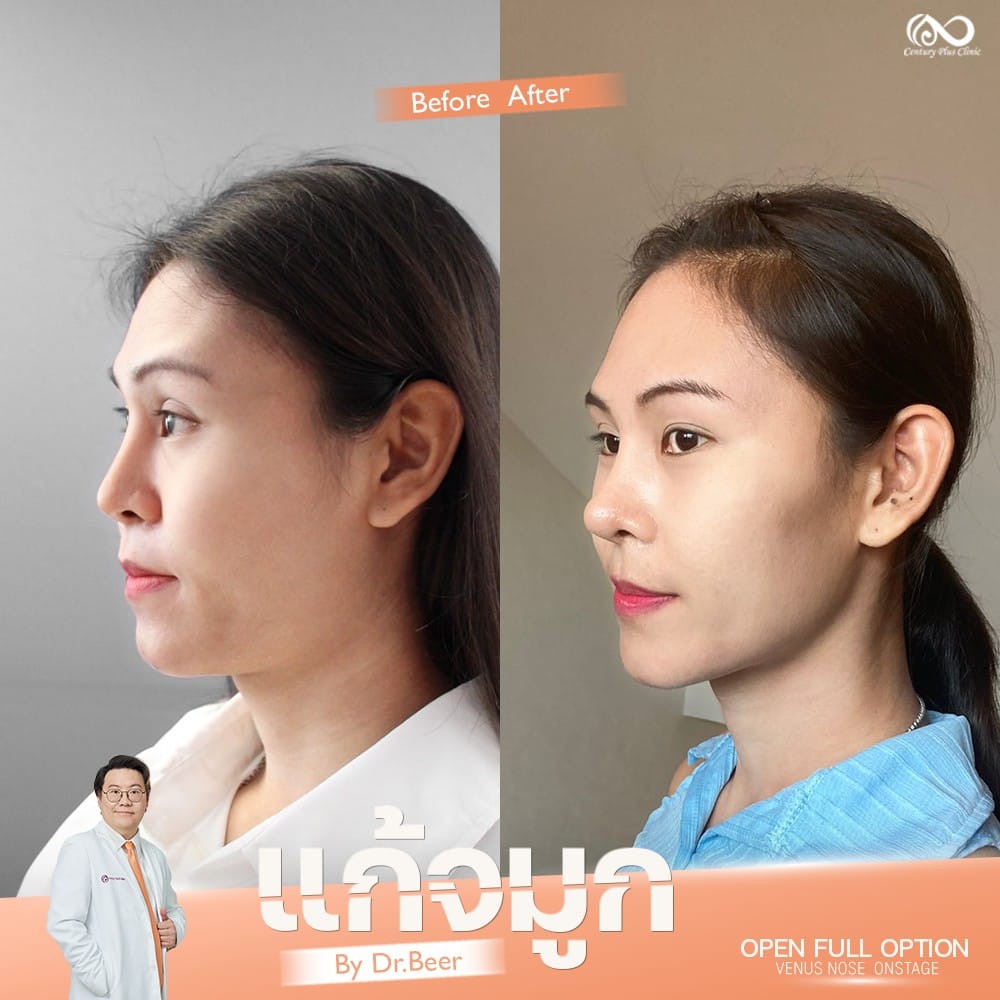 แก้จมูก 2#1319