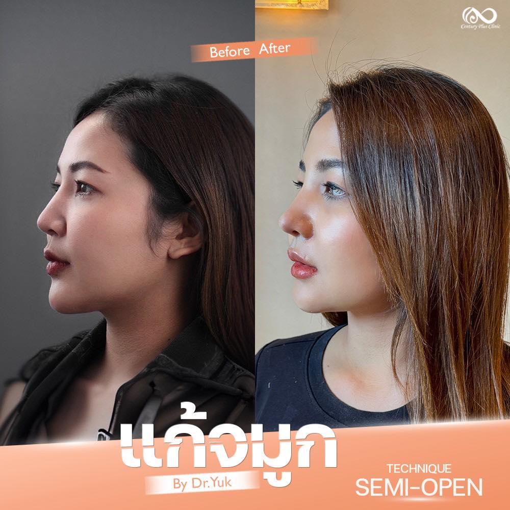 แก้จมูก 2#1320