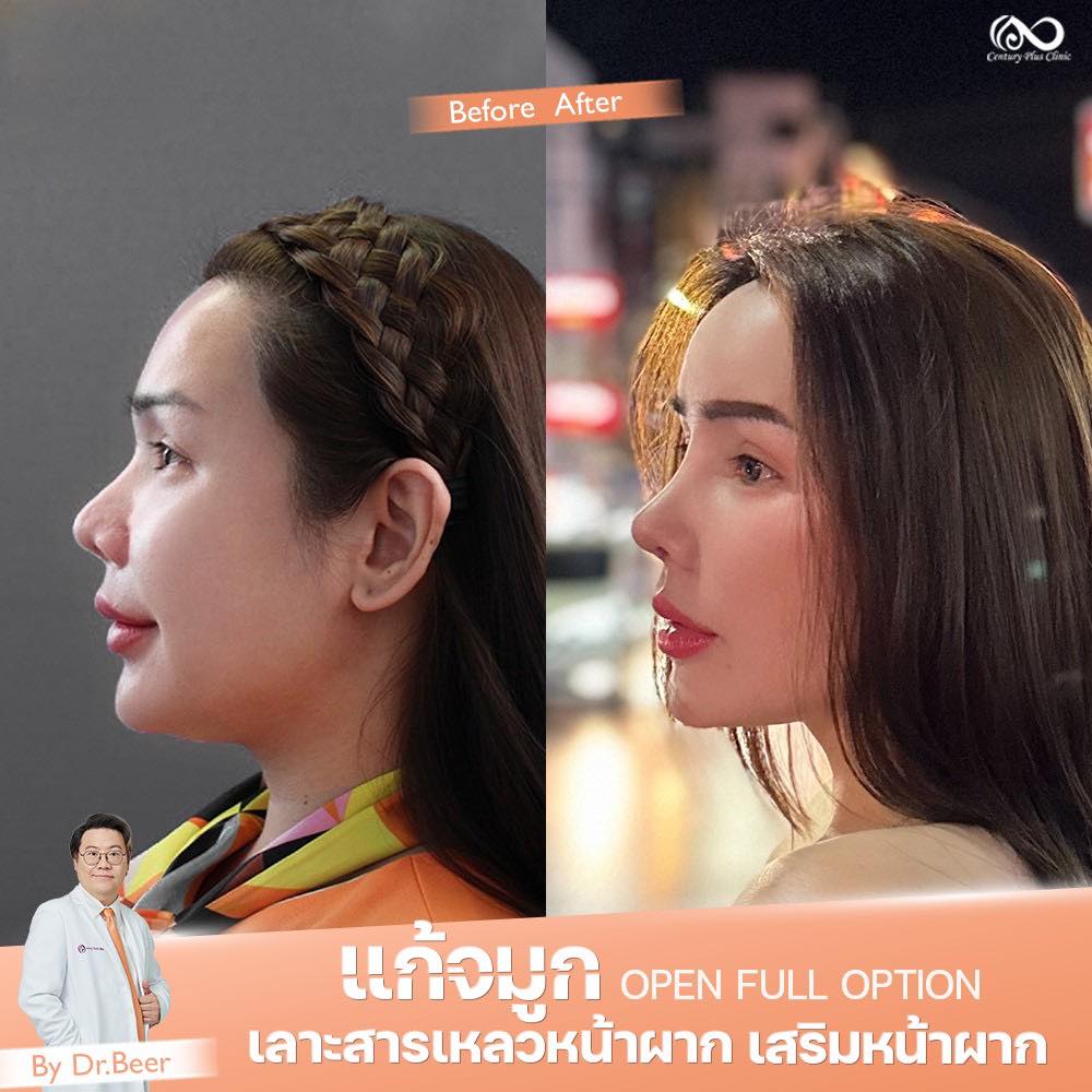 แก้จมูก 2#1321