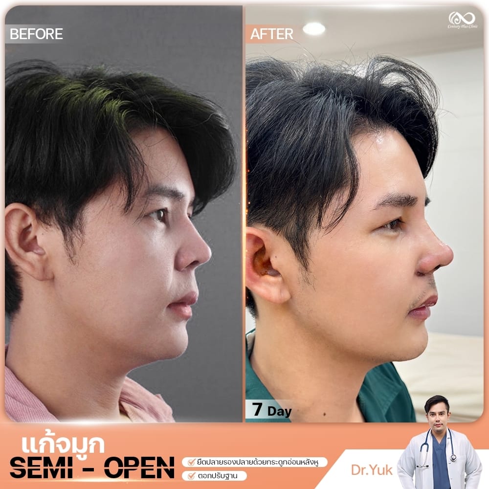 รีวิว แก้จมูก #1342 , Century Clinic Thailand แก้จมูก 2#1342