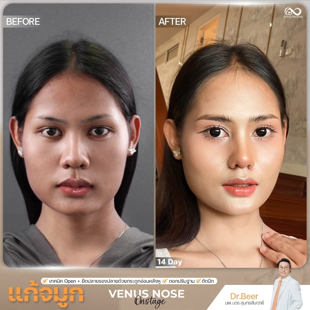 รีวิว แก้จมูก #1349 , Century Clinic Thailand แก้จมูก 2#1349