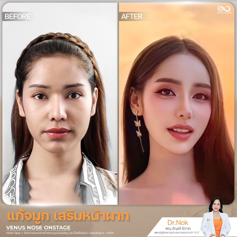 แก้จมูก 2#1351