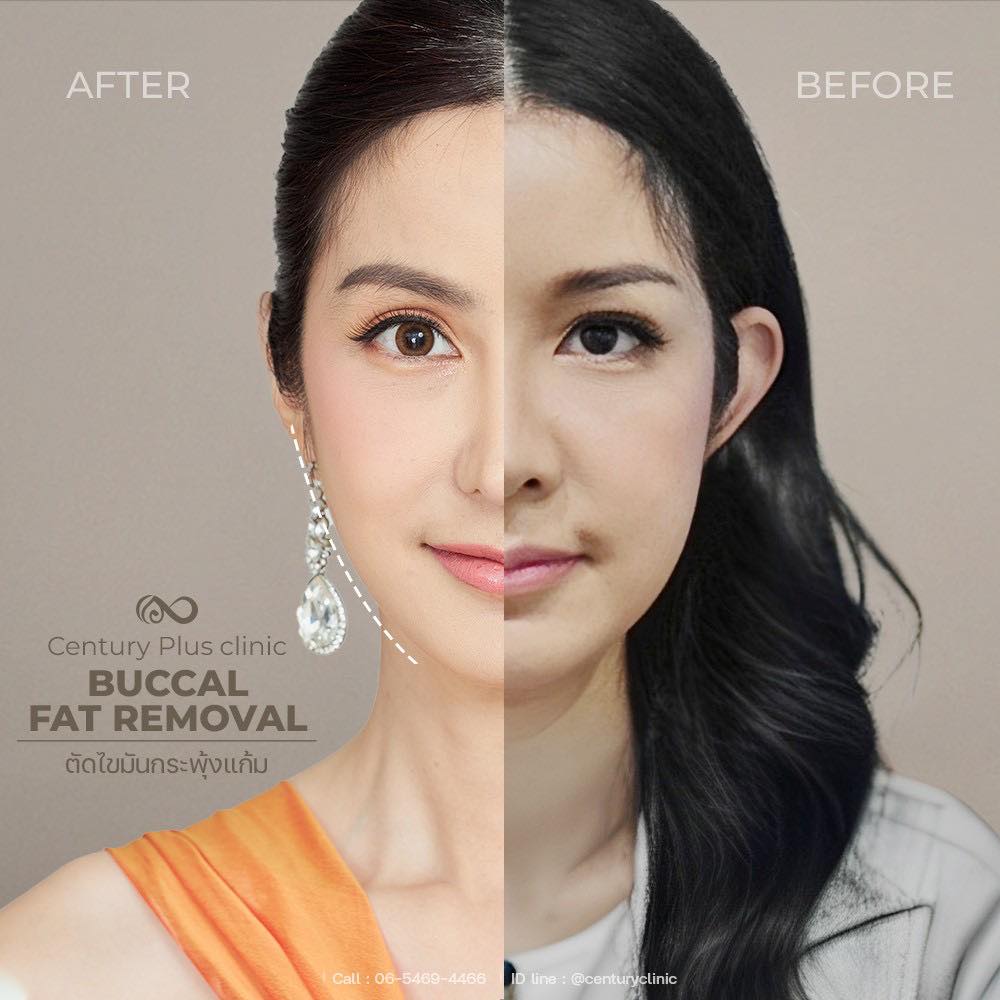 รีวิว ตัดไขมันกระพุ้งแก้ม #13 , Century Clinic Thailand ไขมันกระพุ้งแก้ม