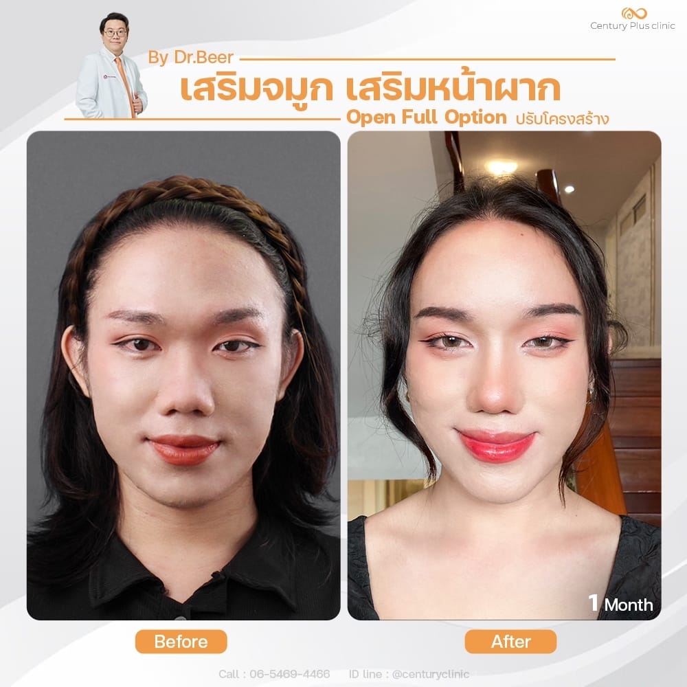 รีวิว เสริมจมูก #1376 , Century Clinic Thailand เสริมจมูก 1#1376