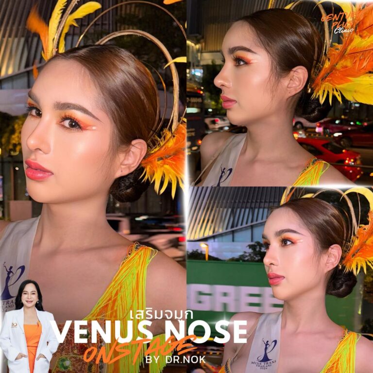 รีวิว เสริมจมูก #1409 , Century Clinic Thailand เสริมจมูก #1409